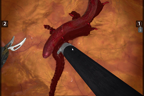 PBD Dissection