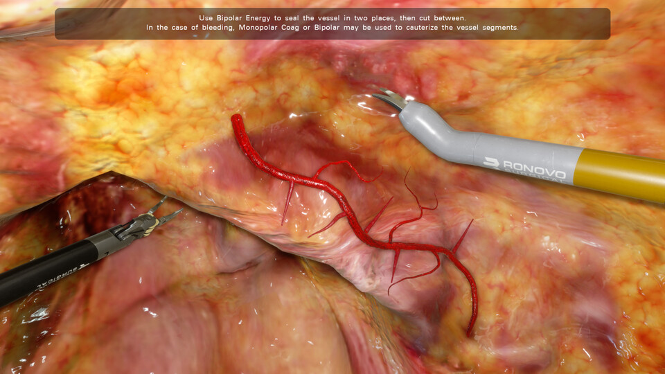 Simulated fatty tissue with a branching blood vessel, lit with wet specular highlights, and two robotic instruments