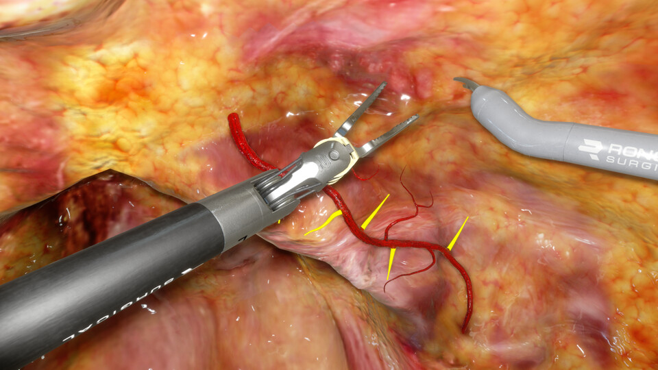 The same tissue scene with a robotic instrument grasping the blood vessel near yellow guide markers