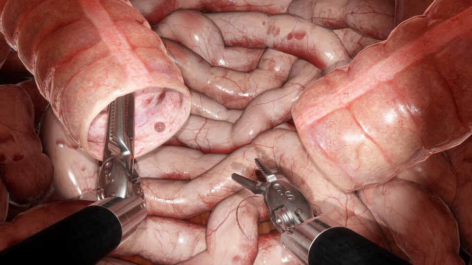 Two robotic instruments holding the open ends of simulated bowel above coiled intestines