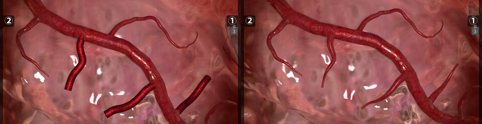 Small vessels: before and after my enhancements