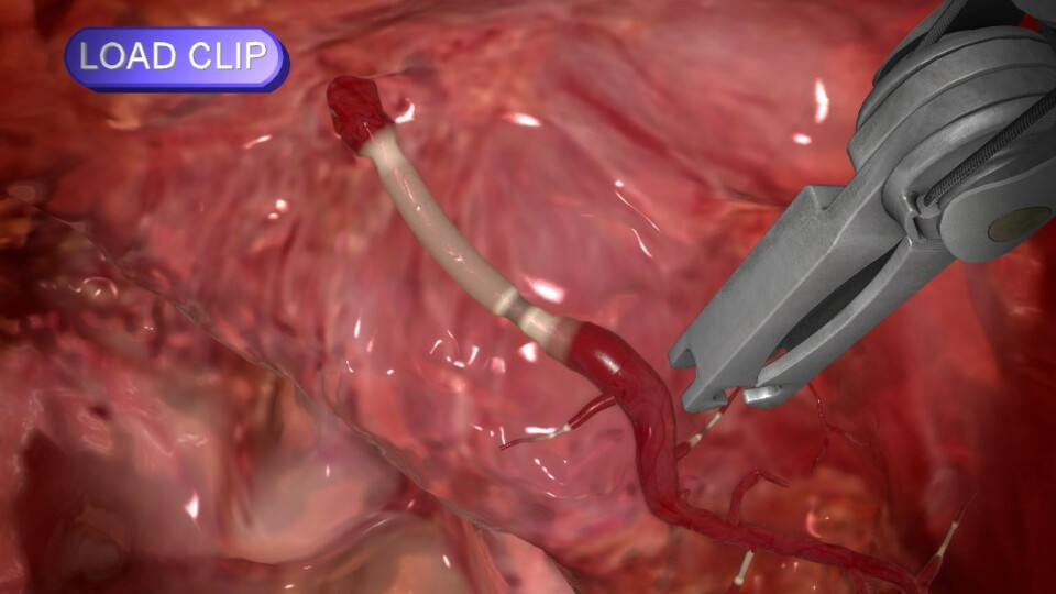 Vessel cauterization